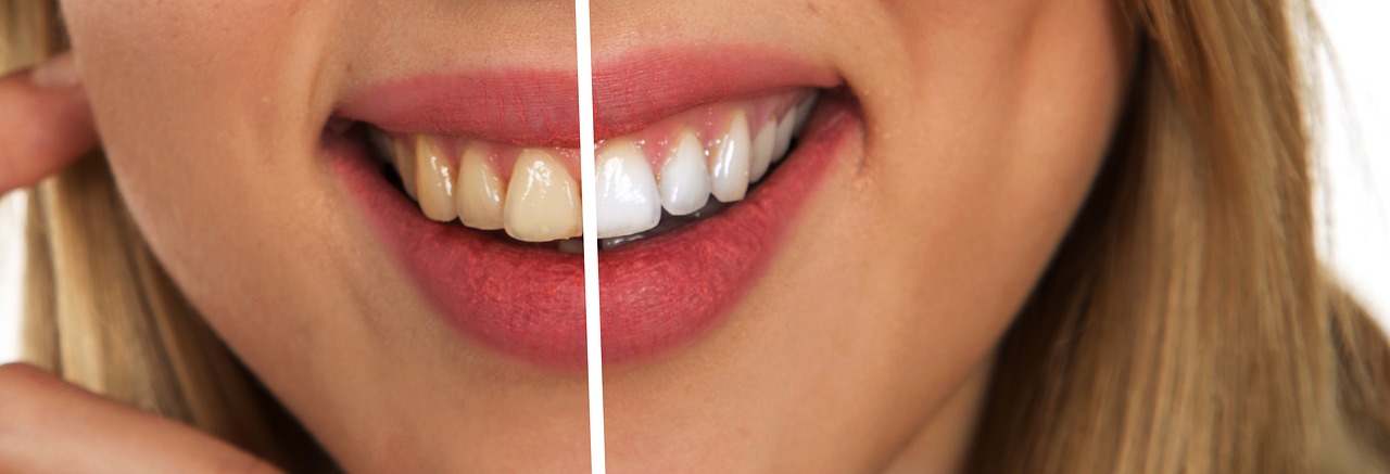 どうすれば歯を白くできますか？？